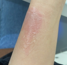 烫伤疤痕