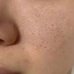 痘坑疤